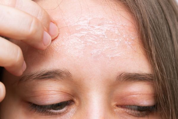 sardiyon me rookhi twacha kyu hoti hai