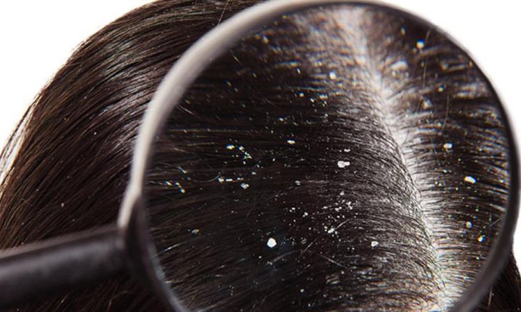 Dandruff Home Remedies:  बस 2 घरेलू नुस्खों से डैंड्रफ होगा कंट्रोल और बालों में आएगी चमक, आप भी जरूर आजमाएं