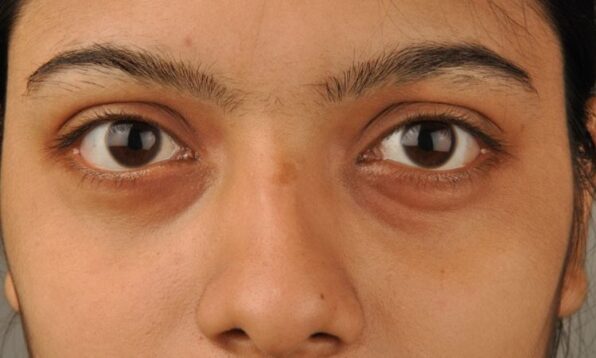 how-to-get-rid-of-puffy-eyes