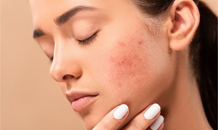 acne prone skin