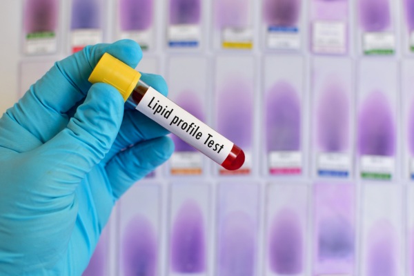 lipid profile test