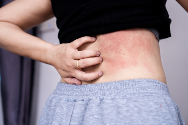 how to get rid of heat rash