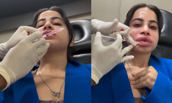 urfi javed lip filler dissolving
