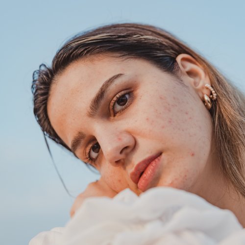 tamannah bhatia acne hack