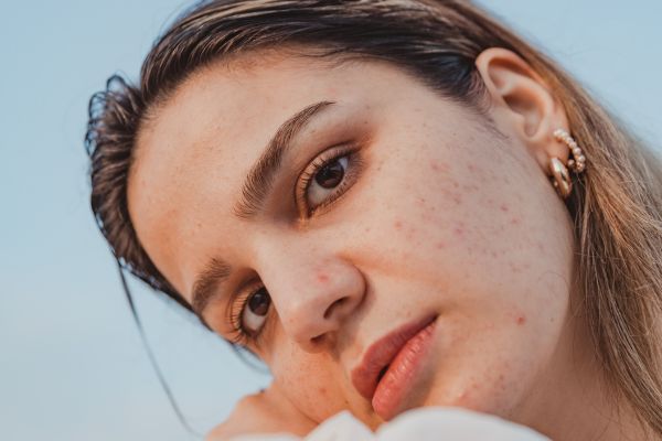 chemical peeling treatments
